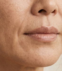 Facial Rejuvenation