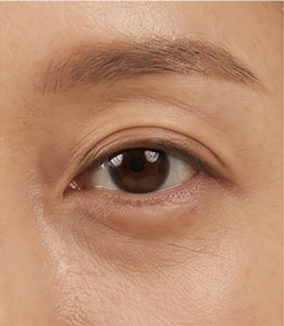Facial Rejuvenation