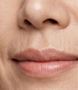 Facial Rejuvenation