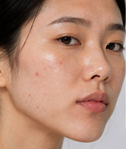 Pigmentation