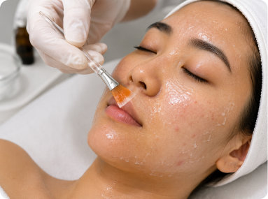 Chemical Peel