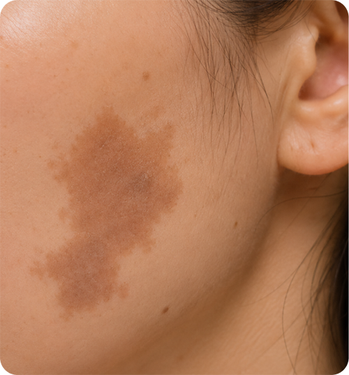 Birthmarks