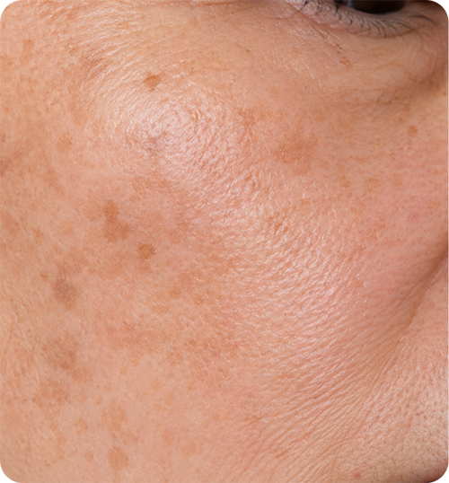 Facial laser treatment