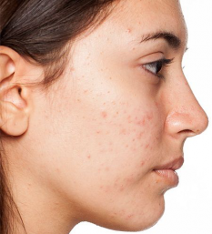 laser peel