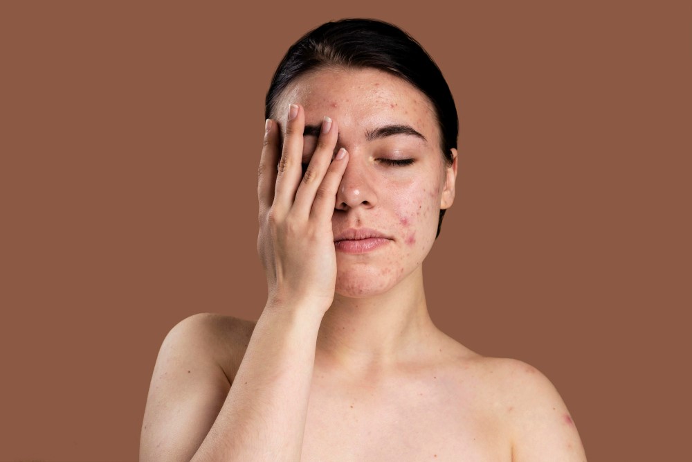 Right Acne Scar Treatment